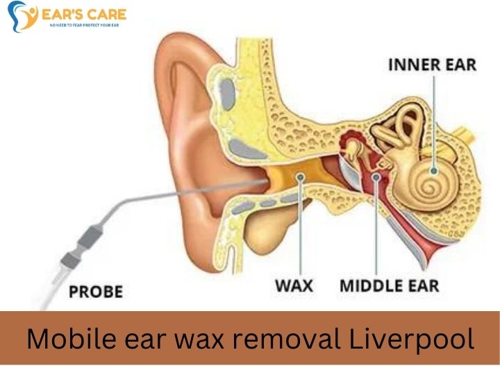 Mobile Ear Syringing Liverpool – professional Ear Cleaning.