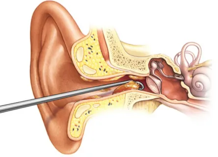 Mobile Ear Wax Removal Liverpool – Say Goodbye to Earwax Buildup in Liverpool